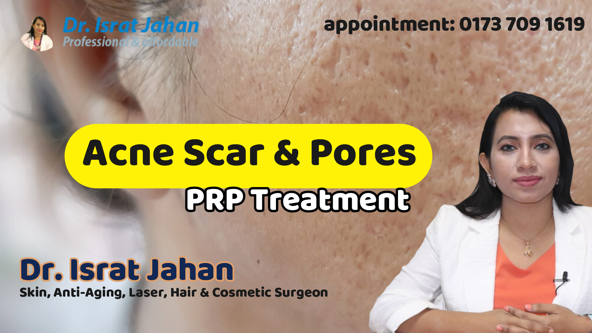 Acne Scar Pores PRP Treatment - Dr. Israt Jahan
