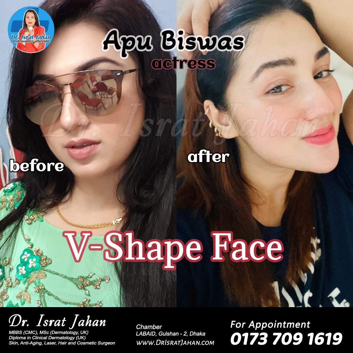 Apu Biswas: V-shaped chin by filler botox threadlift 30min procedure your lunchtime procedure