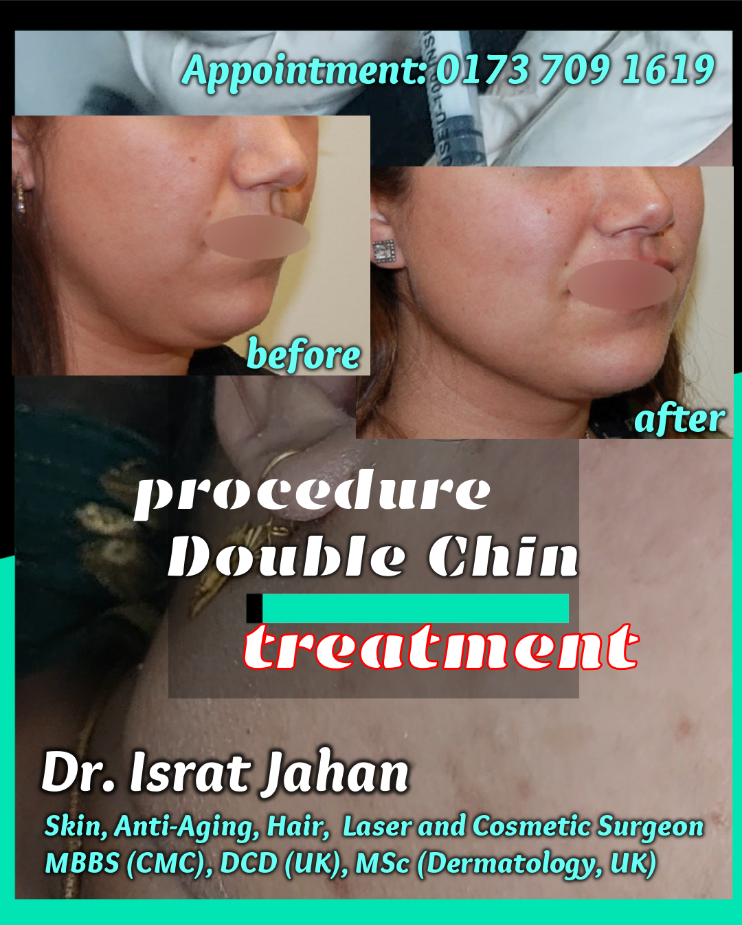 Double Chin Reduction Procedure - ডাবল চিন অথবা সাবমেন্টাল ফ‍্যাট কী আপনার সমস্যা?