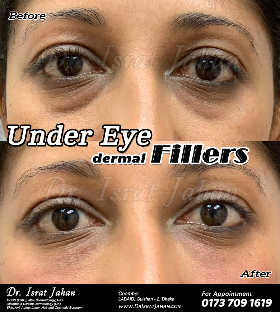 Procedure: Under eye dermal filler