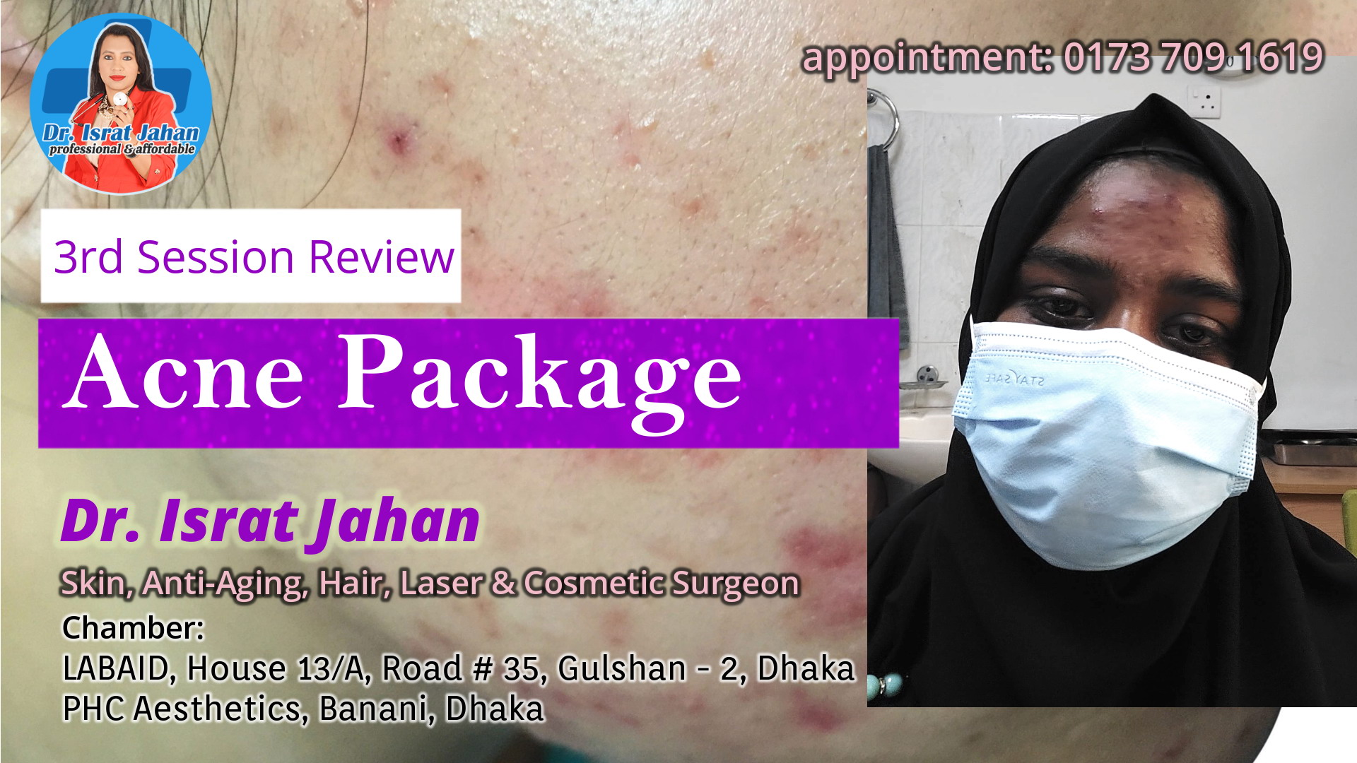 Acne and Acne Scar Package Review 3rd Session Treatment