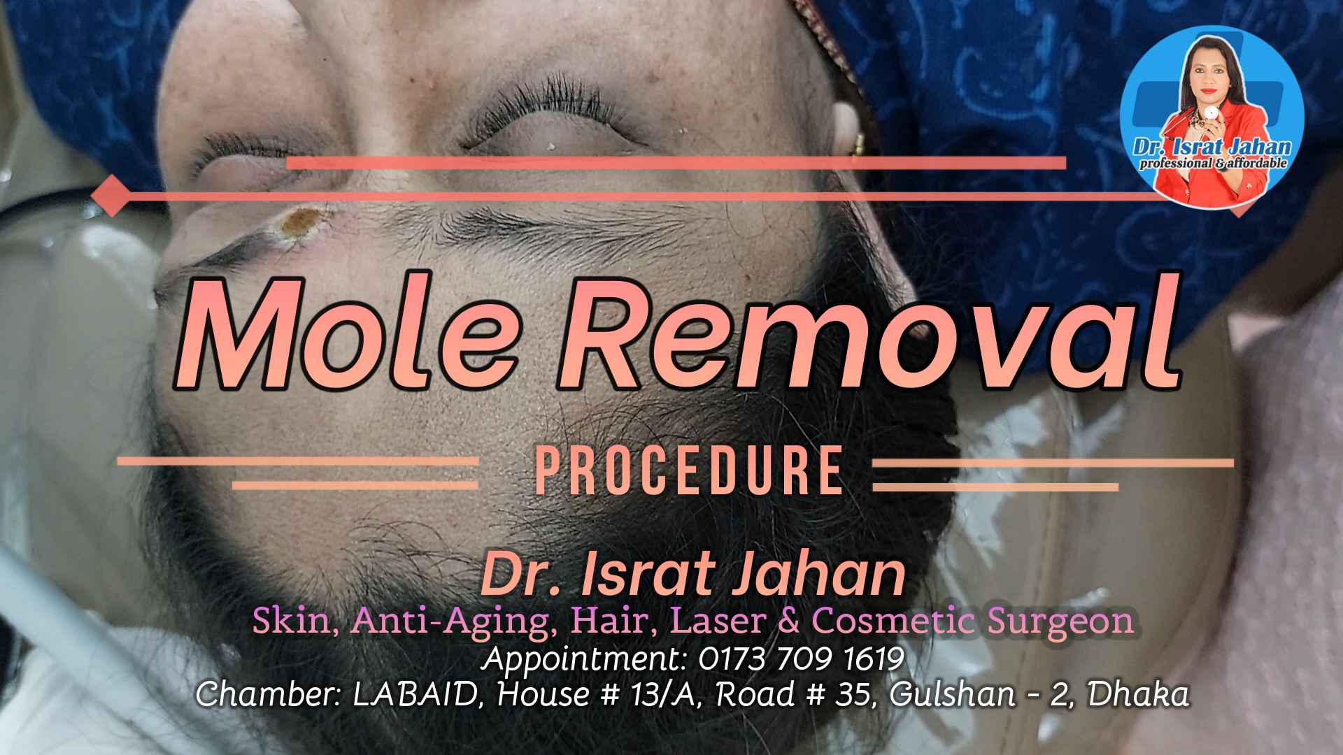 Mole removal - Dr. Israt Jahan