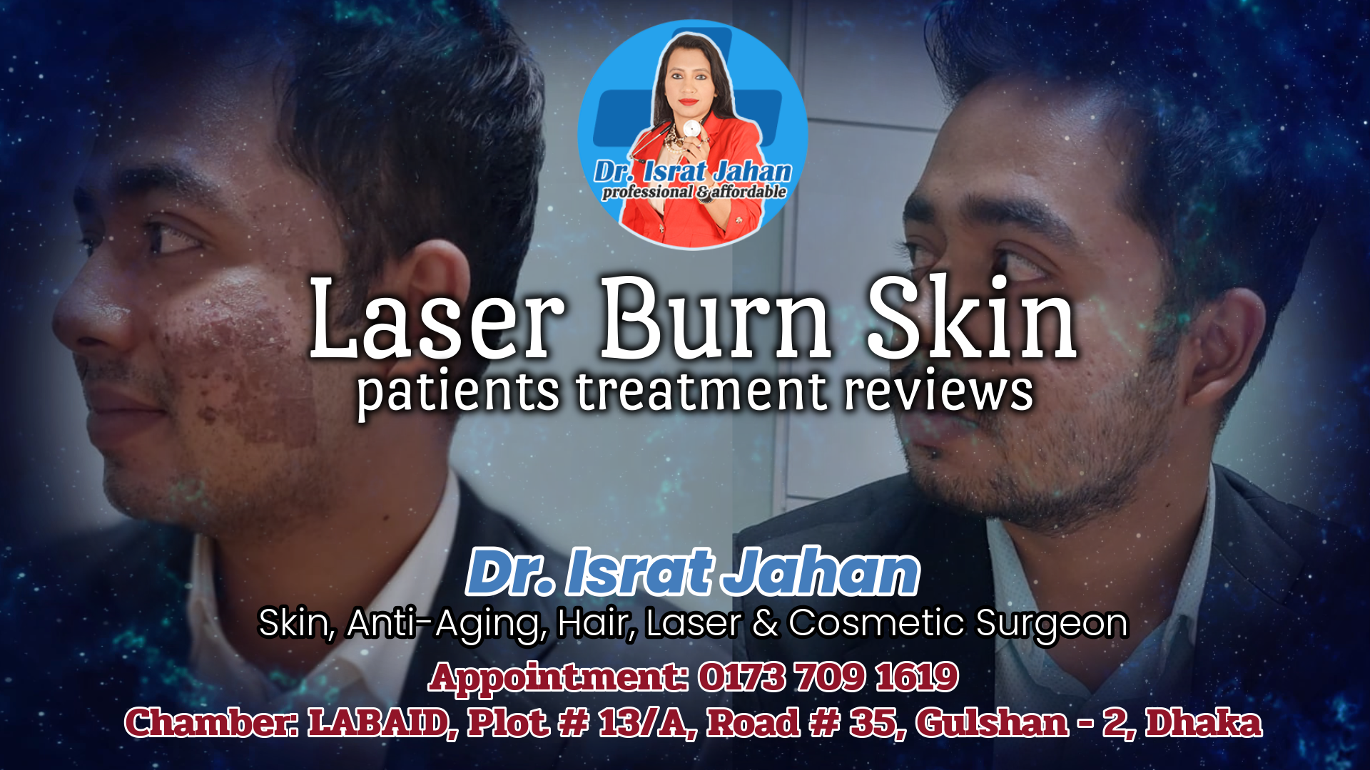 Laser Burn Skin Patients Review by Sakib - Dr. Israt Jahan