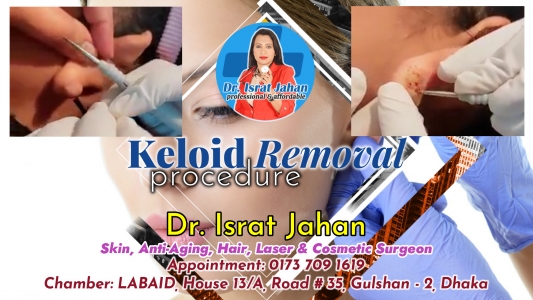 Keloid (on Ear) Removal Procedure - Dr. Israt Jahan