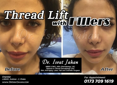 Thread lift for face lifting 