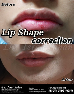 Result of immediately after lip filler