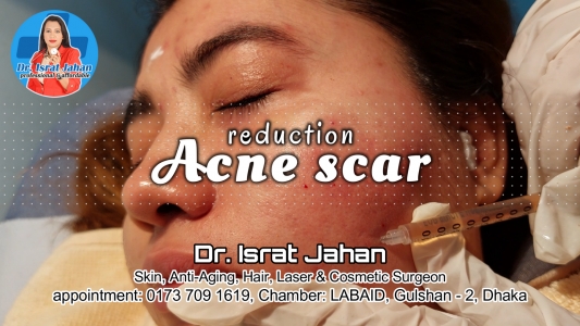 Acne scar reduction - ব্রণের  গর্ত ও ওপেন পোরের চিকিৎসা - Dr. Israt Jahan