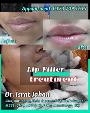 Lip Filler Treatment Procedure: Dr. Israt Jahan