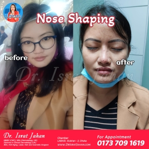 An amazing nose lift done by Dr. Israt Jahan