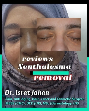 Xanthelasma Removal Patients Review - Dr. Israt Jahan