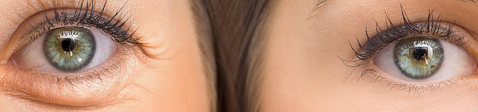 Treatment for Hollow Eyes