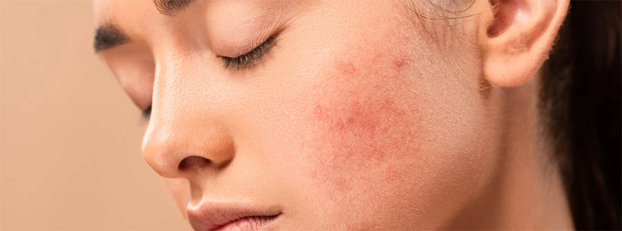 Acne and Acne Scar